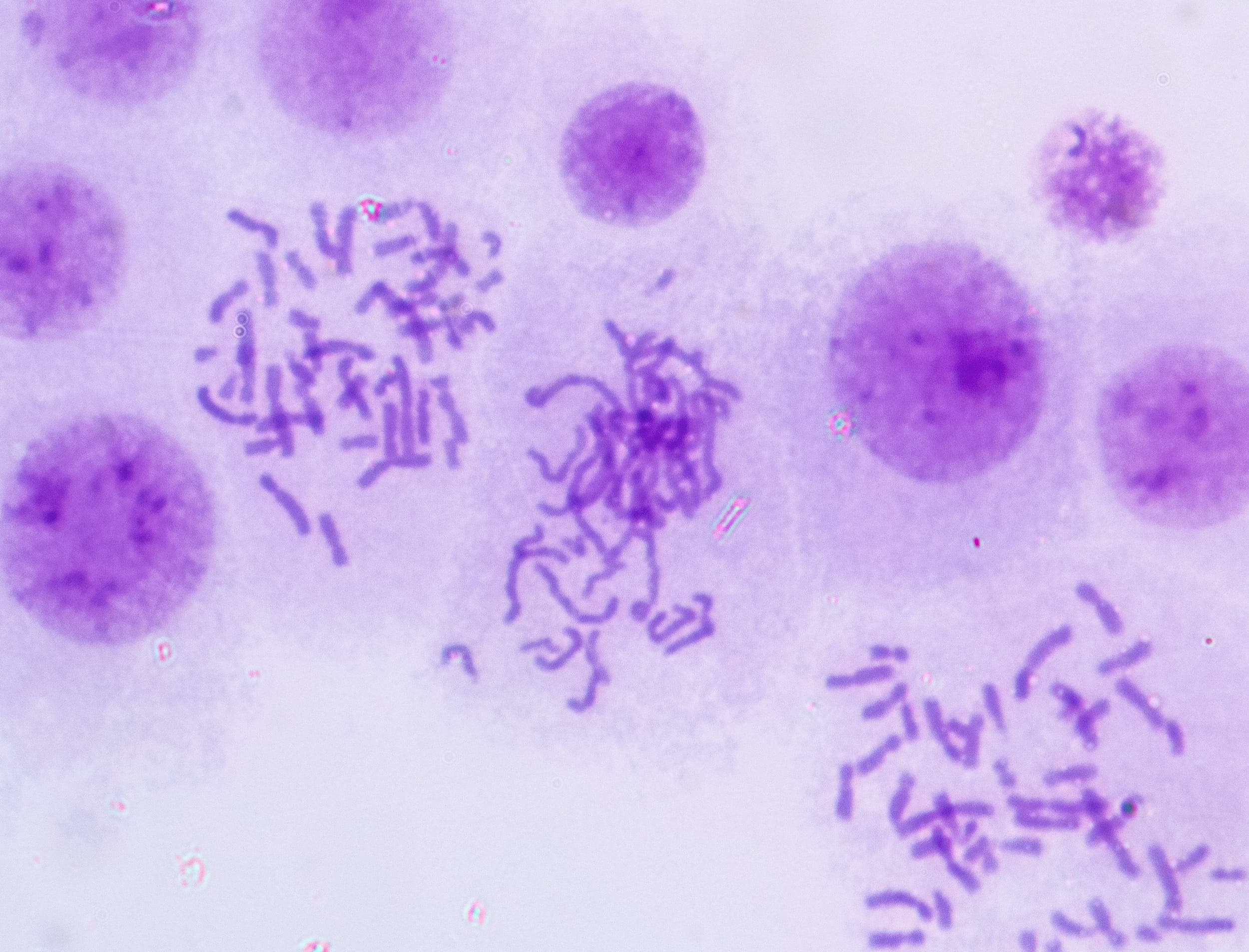 klinefelter syndrome XXY chromosome and fertility