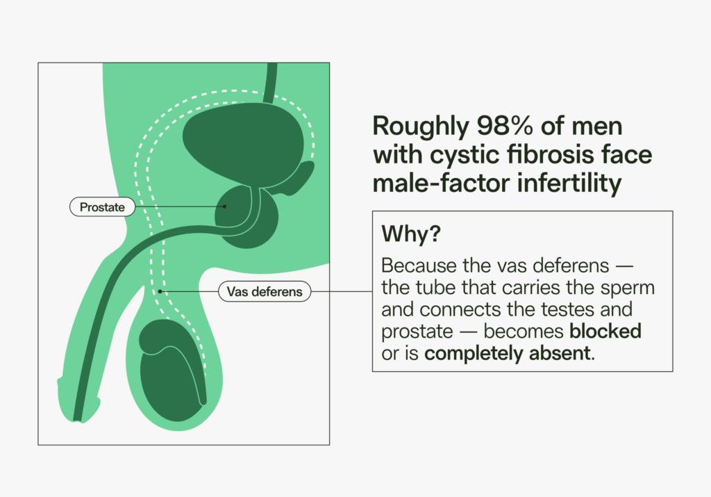 cystic fibrosis and male fertility - 98% of men with cystic fibrosis have male-factor infertility due to lack of vas deferens