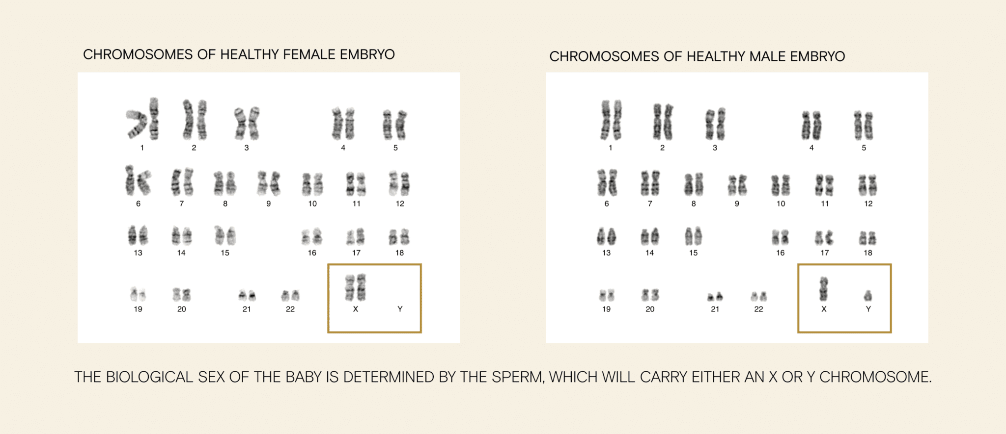 Klinefelter syndrome and fertility How to diagnose and treat XXY