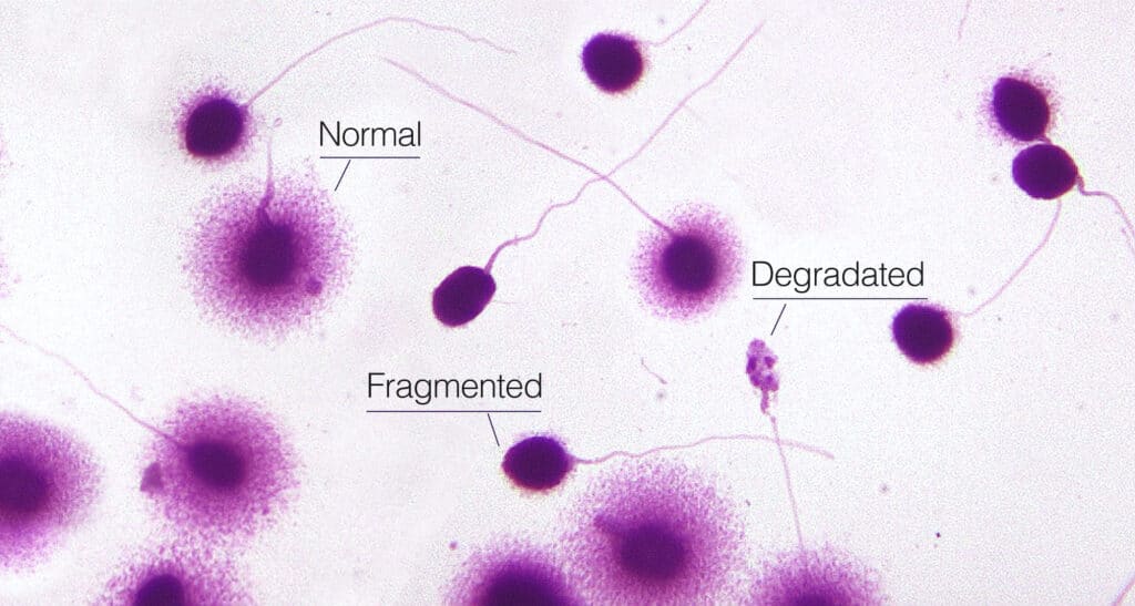Sperm DNA fragmentation testing results
